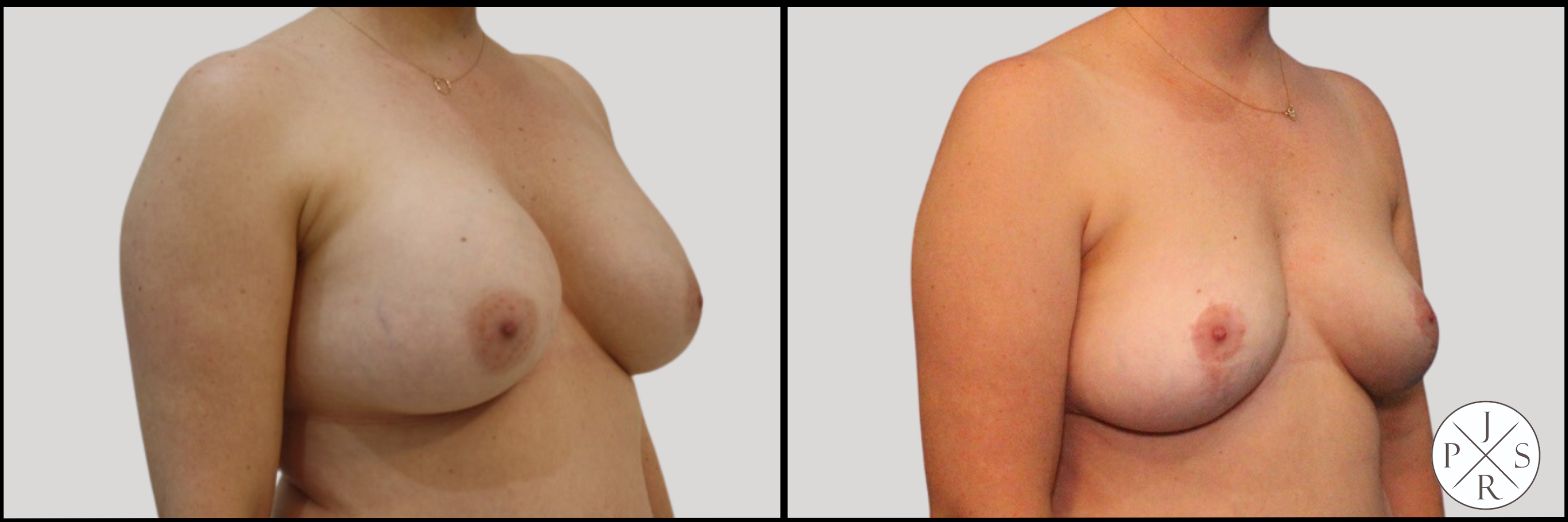 Breast Implant Removal Before & After Image